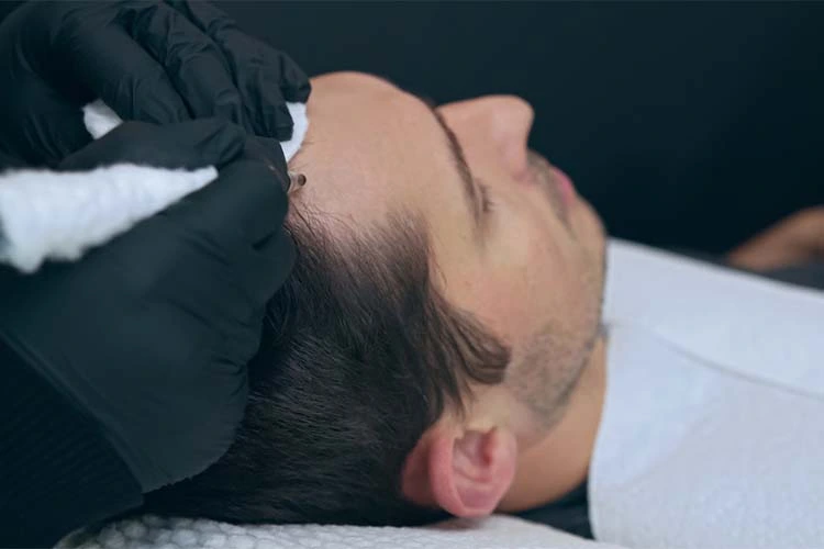 Scalp Micropigmentation in Bangalore